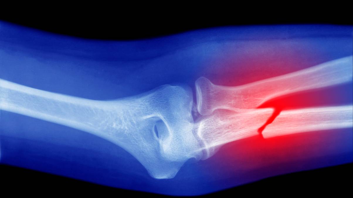 What Your Unbroken Bones Might Secretly Reveal – Doctor Breaks Silence on Strange Theory