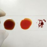Mystery Blood Type Found in Single Woman Could Revolutionize Medicine—What Makes Her Unique?