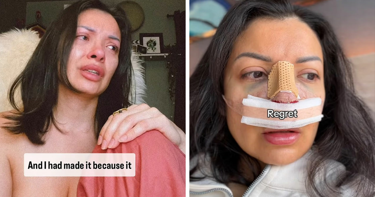 She Spent $6,640 on a Nose Job—Now She Says It Completely Ruined Her Face and Life