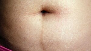 The Mysterious Dark Line on Your Belly Revealed—What It Means Will Surprise You
