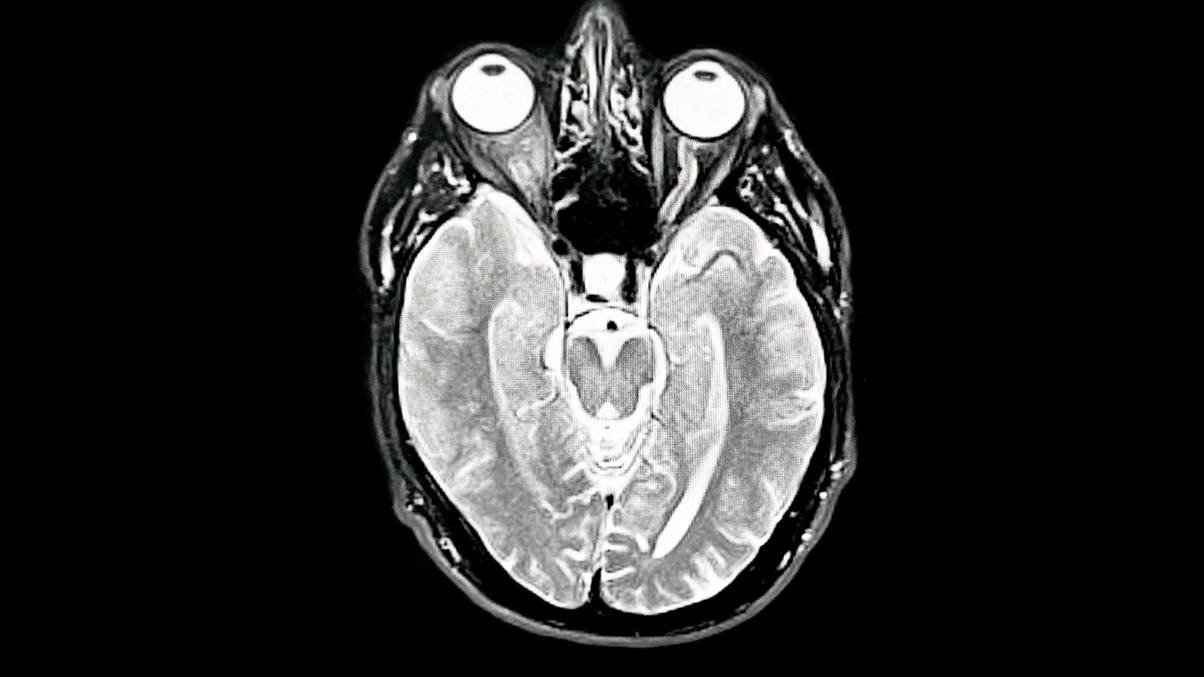 Harvard Unveils Surprising Early Trick That Could Halt Alzheimer's Before It Starts