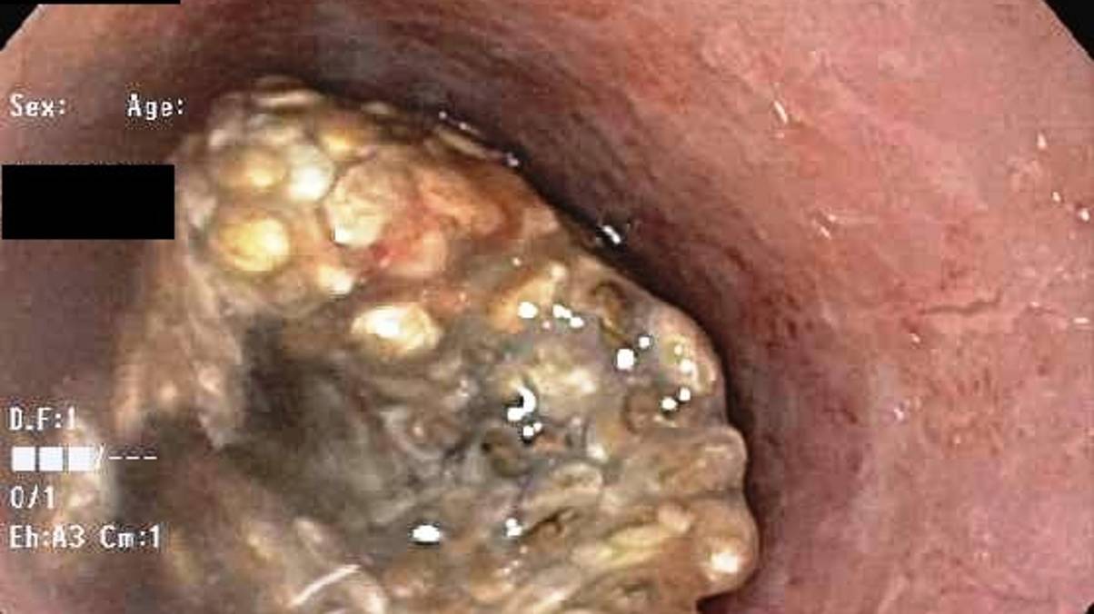Young Man’s Life in Danger After Unexpected Reaction to Popular Superfood—Doctors Stunned