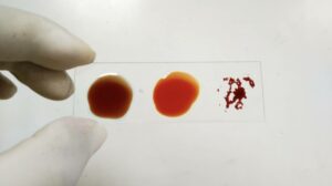 Mystery Blood Type Found in Single Woman Could Revolutionize Medicine—What Makes Her Unique?