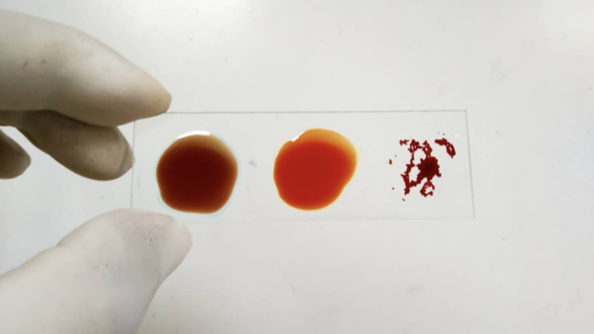 Mystery Blood Type Found in Single Woman Could Revolutionize Medicine—What Makes Her Unique?