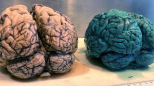 Mystery Pill Turns Patient’s Brain Blue: Doctor Uncovers Shocking TikTok Trend Consequence