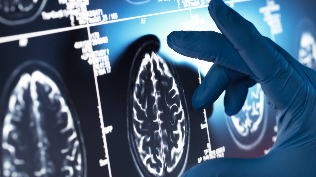 Unlocking the Mystery: Four Surprising Early Signs That Reveal Alzheimer's Long Before Symptoms Appear