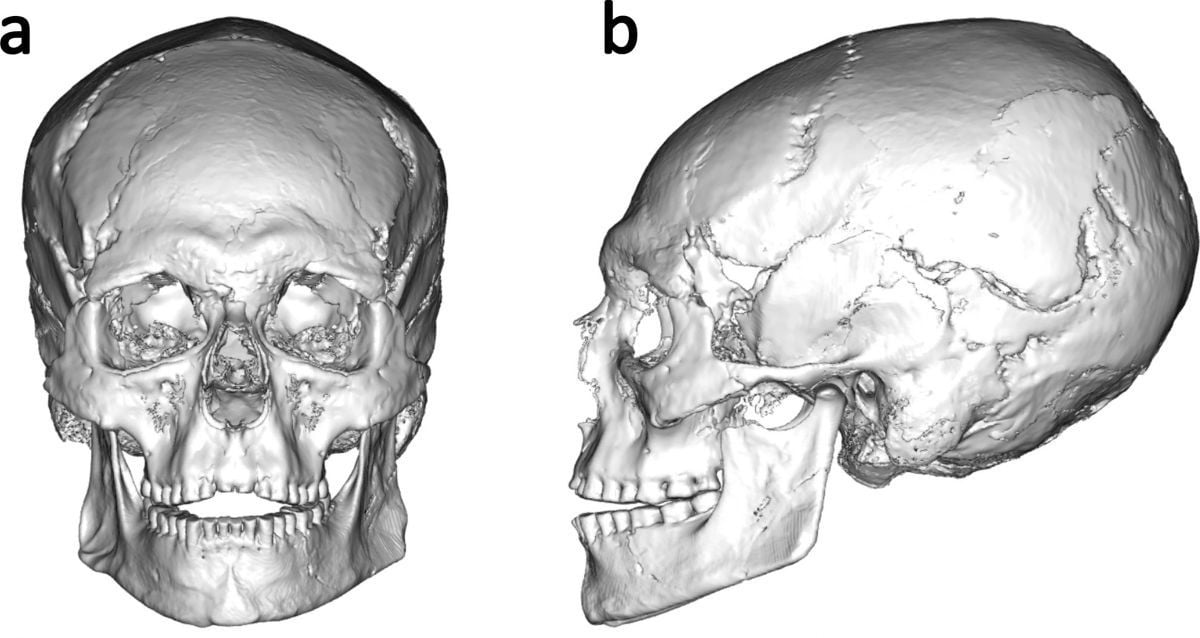 Ancient Mystery Unearthed: 12,500-Year-Old Skull Reveals Europe's Earliest Cranial Modification—What Secrets Does It Hold?