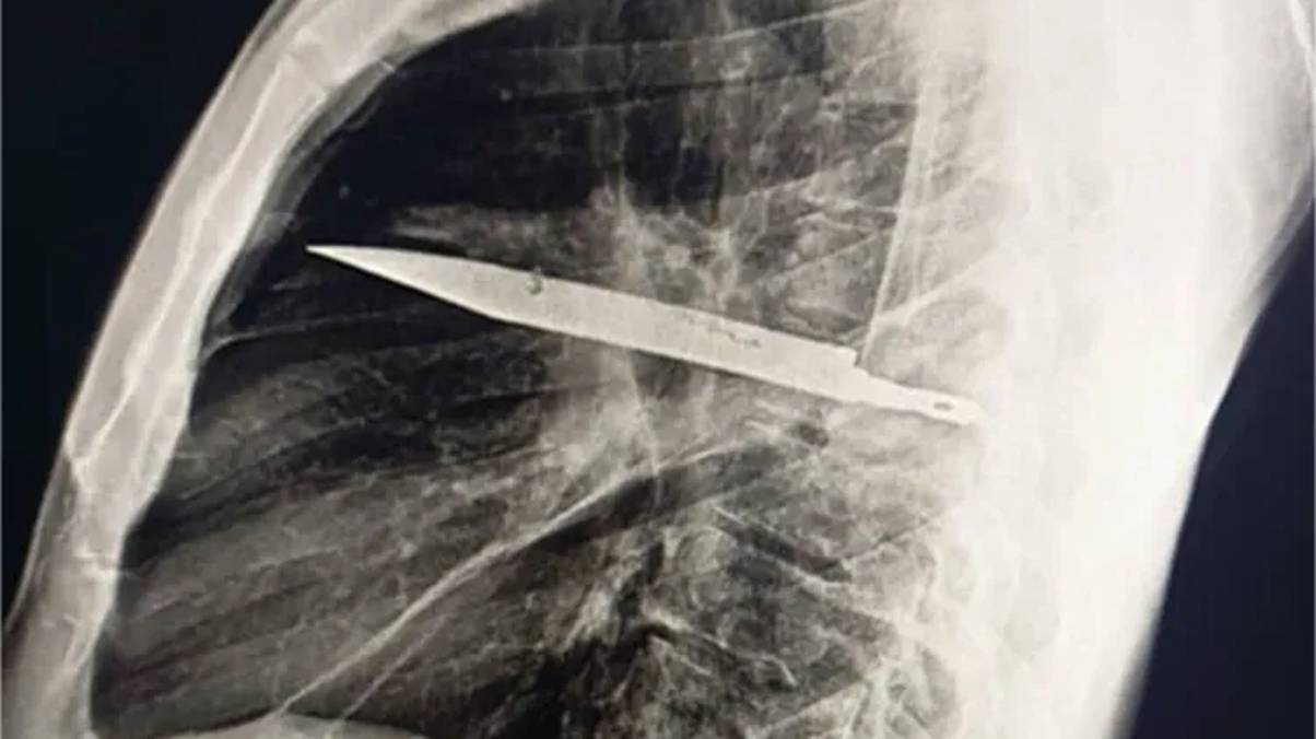 Hidden for Eight Years: The Shocking Discovery Behind a Man’s Leaking Nipple at the Hospital