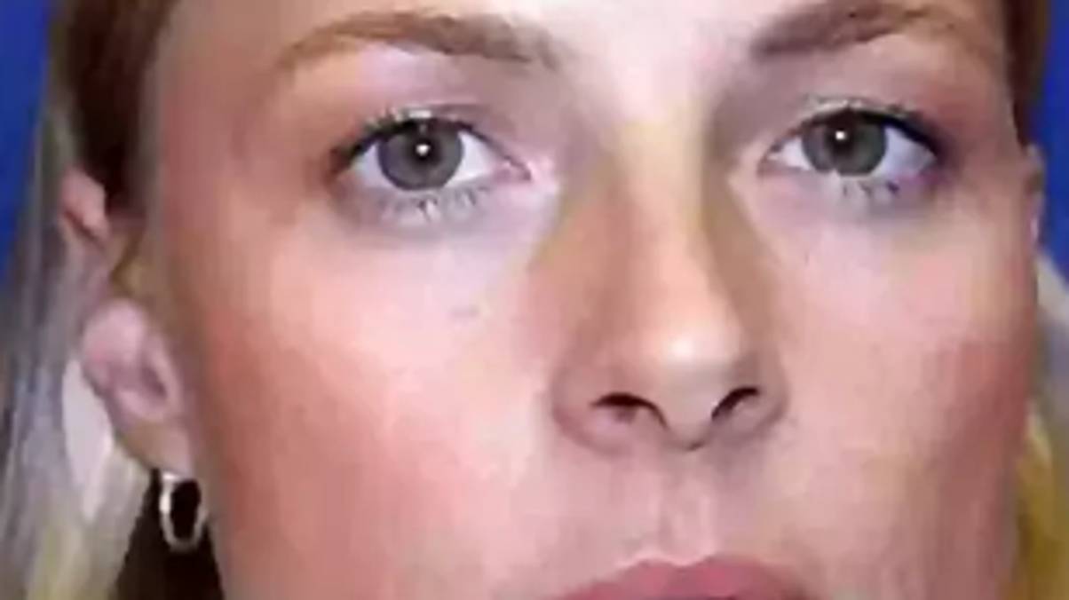 Identical Twins Expose Shocking, Unexpected Consequences of Long-Term Botox Use—You Won't Believe the Outcome!