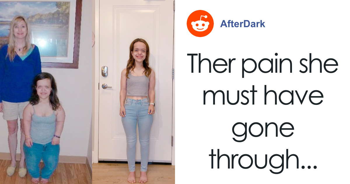From Height Surgery to Stunning Reveal: How This 31-Year-Old Woman Defied Expectations and Transformed Her Life