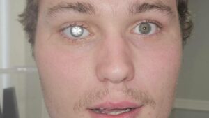 Man Installs $2 Million Diamond in Eye—The Shocking Reason Behind His Daring Transformation Revealed