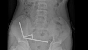 Teen's Shocking Magnetic Mishap: How Swallowing 100 Magnets Led to Life-Threatening Surgery