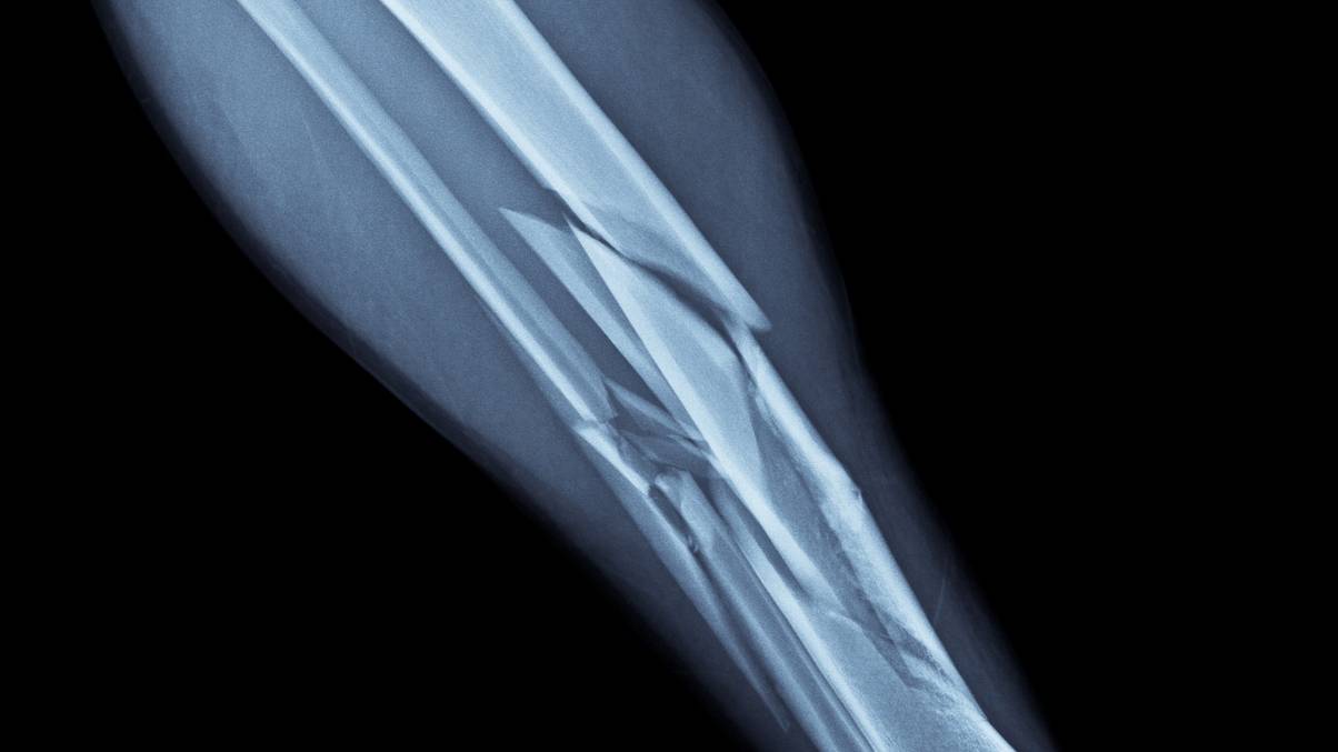 The Shocking Truth Behind Broken Bones: Why Adults and Kids Heal in Mysteriously Different Ways