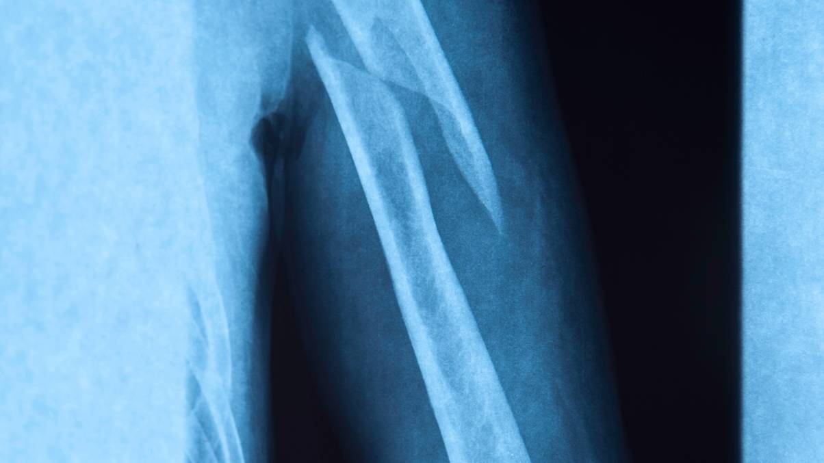 The Unbelievable Truth Behind People Who’ve Never Broken a Bone—Revealed by a Doctor