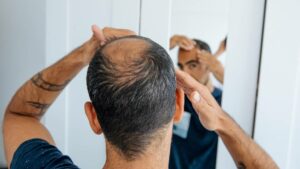 Uncovering the Hidden Link Between Creatine and Hair Loss: What the Latest Research Reveals