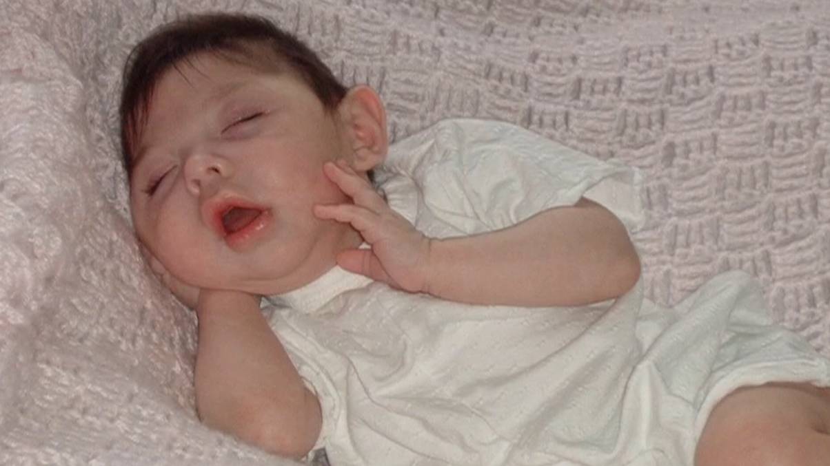 Miracle of Modern Medicine: Woman Born Without a Brain Celebrates 20 Years Against All Odds