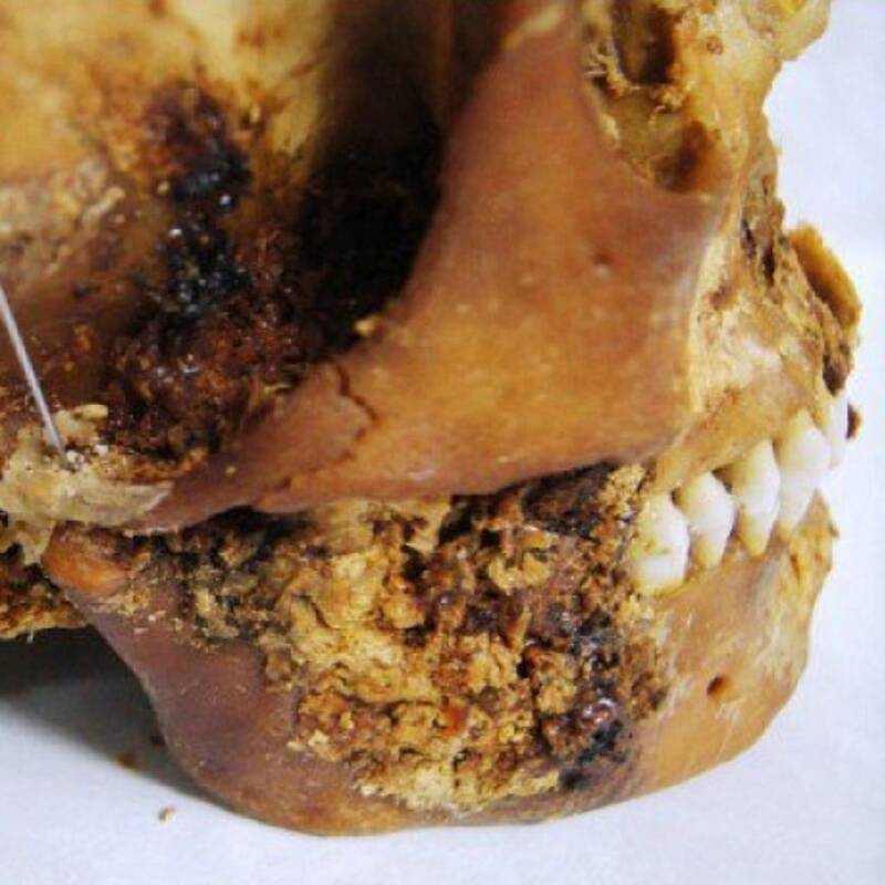 Ancient Siberian Ice Mummy Reveals Mysterious 2,500-Year-Old Jaw Surgery—What Did They Discover?