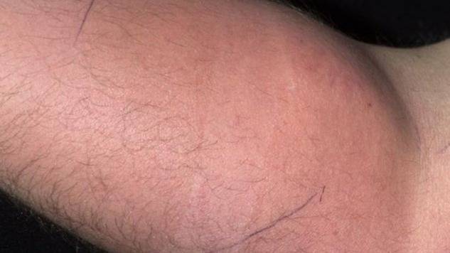 Man Injected Semen Into His Arm for 18 Months—Doctors Stunned by What They Found Next