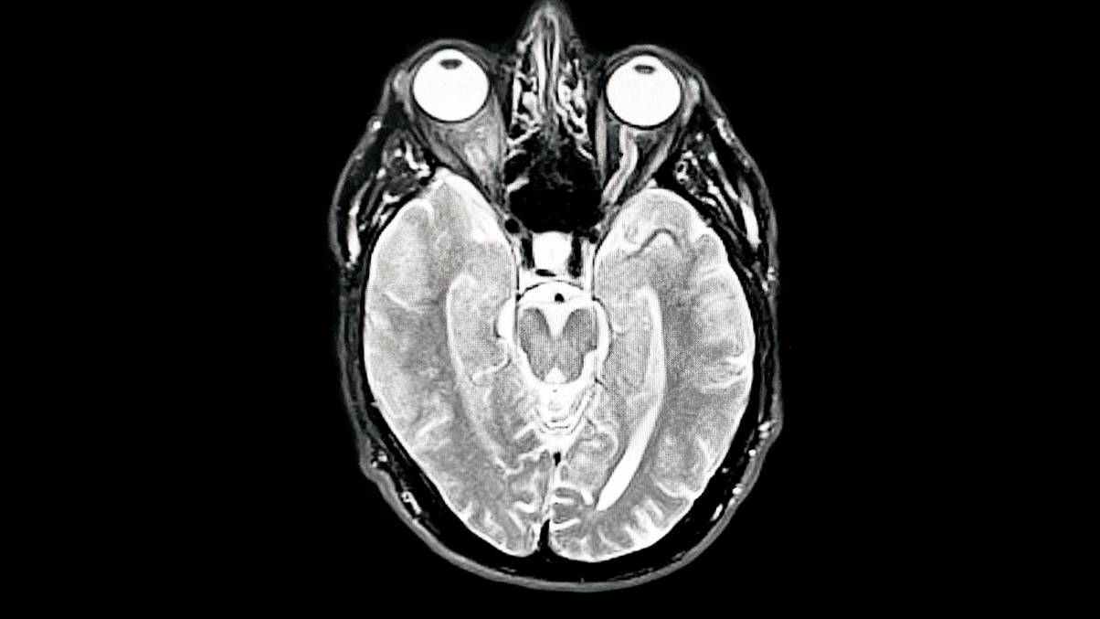 Unlocking the Vitamin C Mystery: A Shocking Link to Alzheimer's Brain Effects Revealed