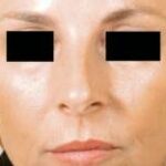 Twin Faces Diverge Dramatically After 20 Years—Botox the Silent Sculptor?