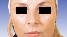 Twin Faces Diverge Dramatically After 20 Years—Botox the Silent Sculptor?
