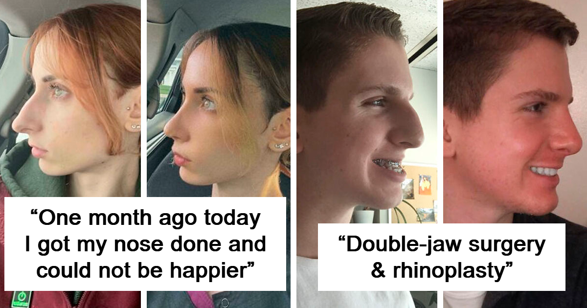 You Won't Believe How These Plastic Surgeries Transformed People's Faces Beyond Recognition!