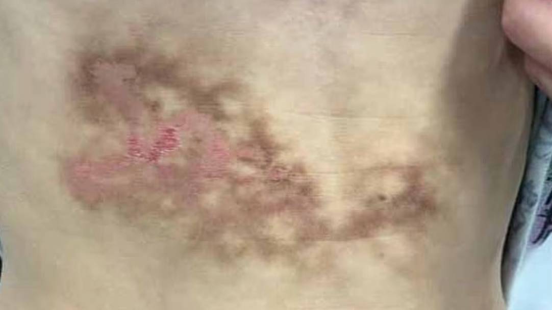 Homeschooling Hazard: Rare 'Toasted Skin Syndrome' Strikes Child, Doctors Sound Alarm