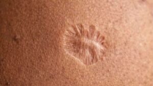 The Mysterious Scar Connecting Millions Worldwide—What’s the Shocking Truth Behind It?