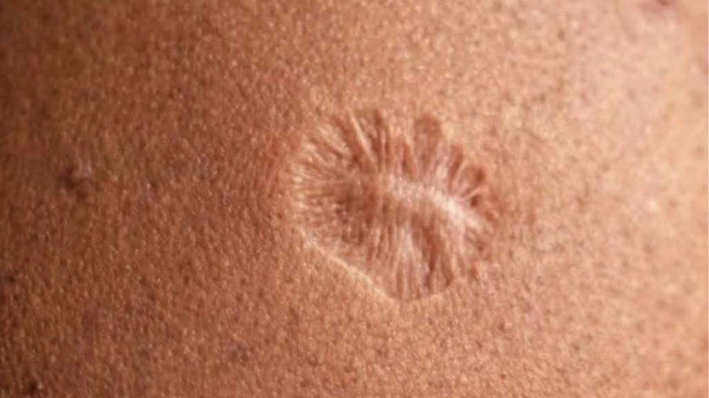 The Mysterious Scar Connecting Millions Worldwide—What’s the Shocking Truth Behind It?